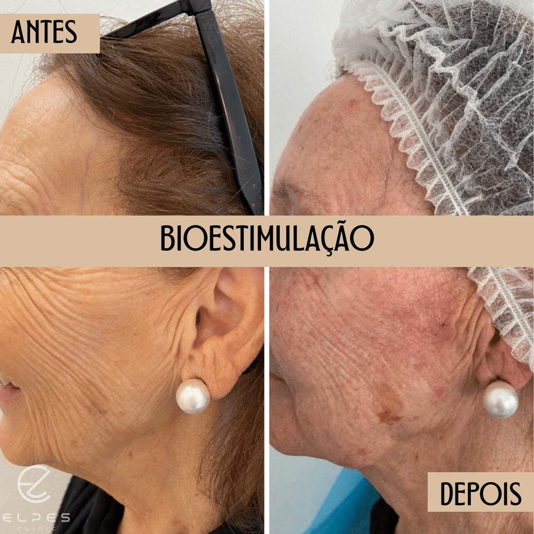 BIOESTIMULADORES DE COLAGÉNIO - Elpes CLinic