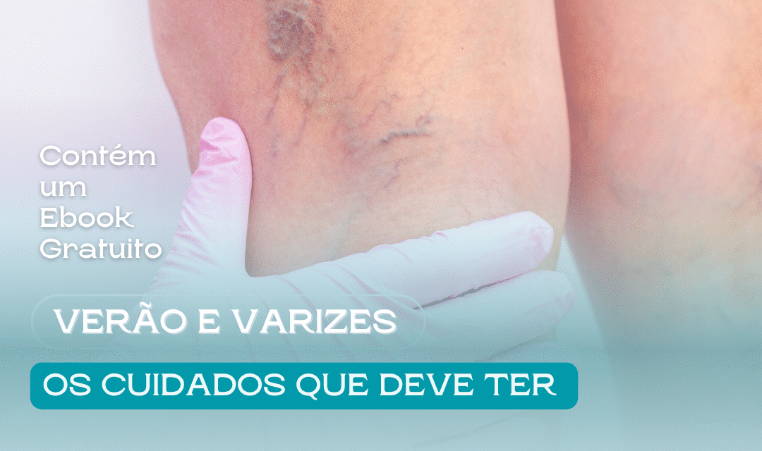 Varizes