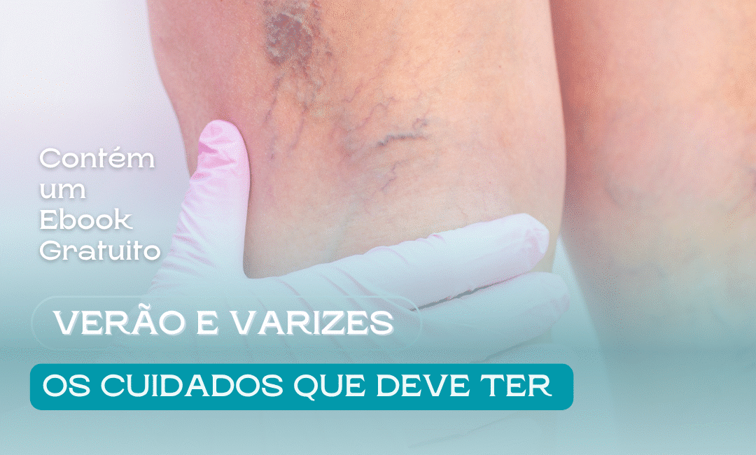 Como Tratar Varizes no Verão e Durante Viagens: Dicas da Dra. Elsie Lopes